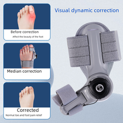 Upgraded Adjustable Bunion Corrector Epictop store